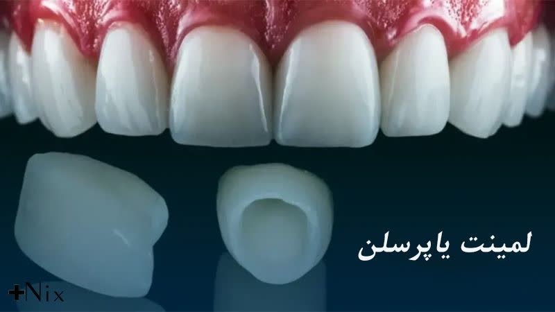 لمینت پرسلن
