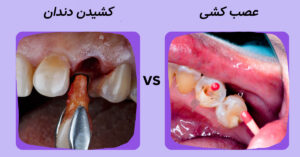 درمان ریشه دندان