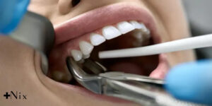 تغذیه بعد از کشیدن دندان