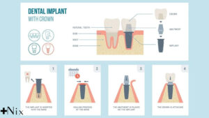 اباتمنت ایمپلنت دندان