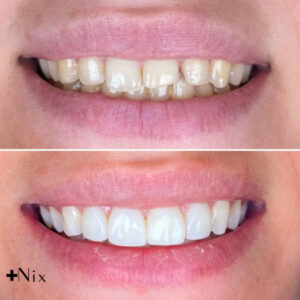 حساسیت بعد از کامپوزیت دندان