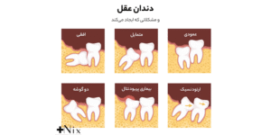 مراقبت بعد از جراحی دندان عقل