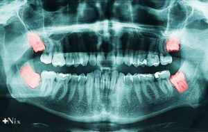 مراقبت بعد از جراحی دندان عقل