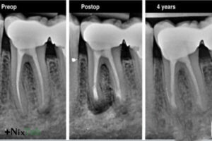دندان عقل نهفته