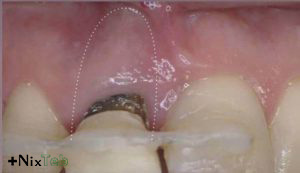 پوسیدگی عمیق دندان