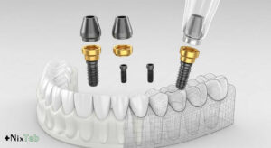 ایمپلنت ایرانی