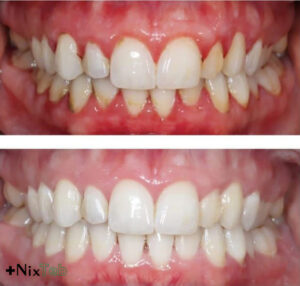 مزایای جرمگیری دندان