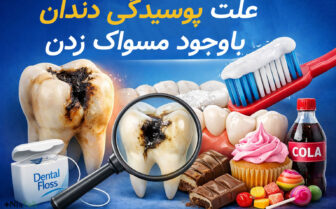 پوسیدگی دندان با وجود مسواک زدن