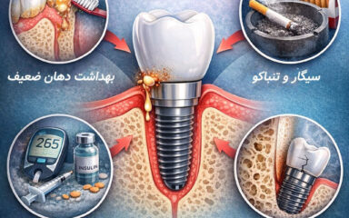 عوارض ایمپلنت دندان