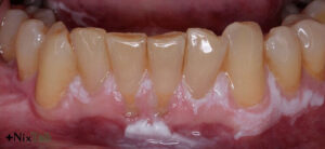 علائم آبسه دندان