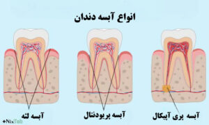 پیشگیری آبسه دندان